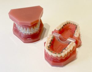 歯列矯正　模型
